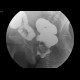 Rectovaginal fistula, diverticular disease of the sigmoid colon: RF - Fluoroscopy